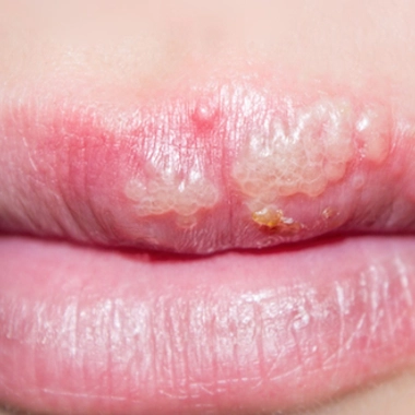 Labial, génital, oculaire : comment soigner l'herpès ?