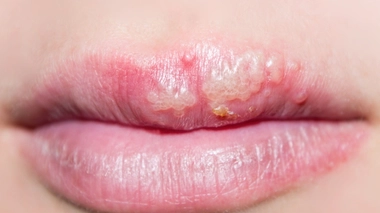 Labial, génital, oculaire : comment soigner l'herpès ?