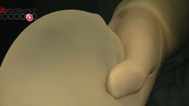 Implants mammaires texturés : des femmes portent plainte contre X