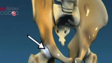 Fracture du col du fémur