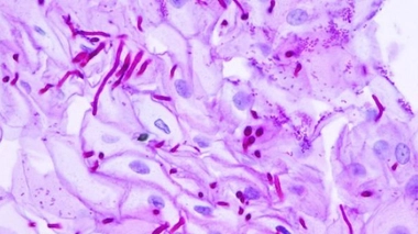 L'inexorable progression des infections fongiques invasives