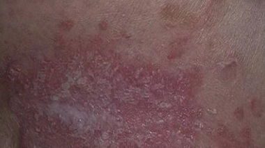 Mycoses cutanées : rappel de flacons de la marque Pevaryl®