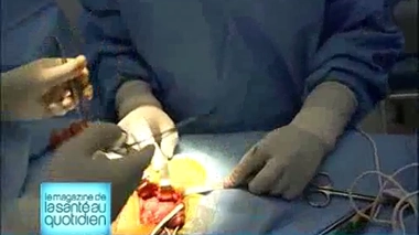 Attention, images d'intervention chirurgicale : la cicatrice dépend de la technique choisie par le chirurgien.