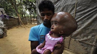 Inde : l'opération de la fillette hydrocéphale est un succès