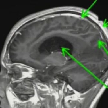 Hydrocéphalie, une tête qui grossit