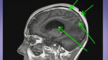Hydrocéphalie, une tête qui grossit