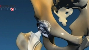 Les prothèses orthopédiques Ceraver sont retirées du marché