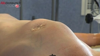 Tumeurs desmoïdes : causes et traitements